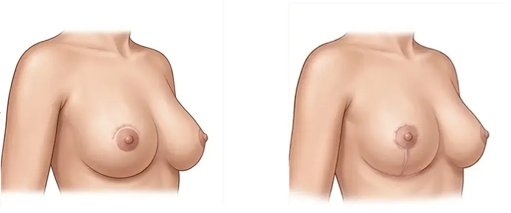 Schéma d'oncoplastie de remodelage : ablation de la tumeur, remodelage du sein et cicatrices en T
